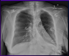 <p>Which imaging modality is best to further characterize this patients condition? </p><p>a. MRI with contrast </p><p>b. Chest CT without contrast </p><p>c. A nuclear imaging perfusion/ventilation study </p><p>d. PET scan of Chest</p>
