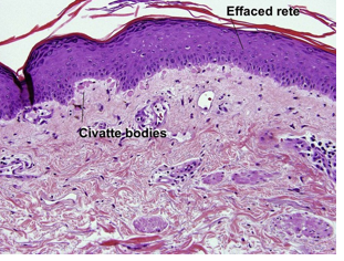 <ul><li><p>Dense infiltrate of lymphocytes (mostly <strong>T Lymphocytes</strong>) along the <strong>DEJ</strong></p></li><li><p>Keratinocytes under attack clump tg → form <span style="color: red;"><strong>Colloid/Civatte bodies</strong></span><strong> (</strong>dense eosinophilic globules)</p></li><li><p>Chronic inflammation causes<strong> </strong><span style="color: red;"><strong>hyperkeratosis and flattening of rete ridges</strong></span><strong>, “Sawtooth” </strong>rete ridges in established lesions.</p></li></ul><p></p>