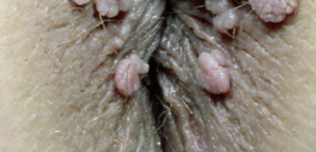 <p>⚠️‼️(#13,#35)78.Identify the lesion. A.Granuloma inguinale B.Herpes simplex type 2 C.Lymphogranuloma venereum D.Condyloma acuminata</p>