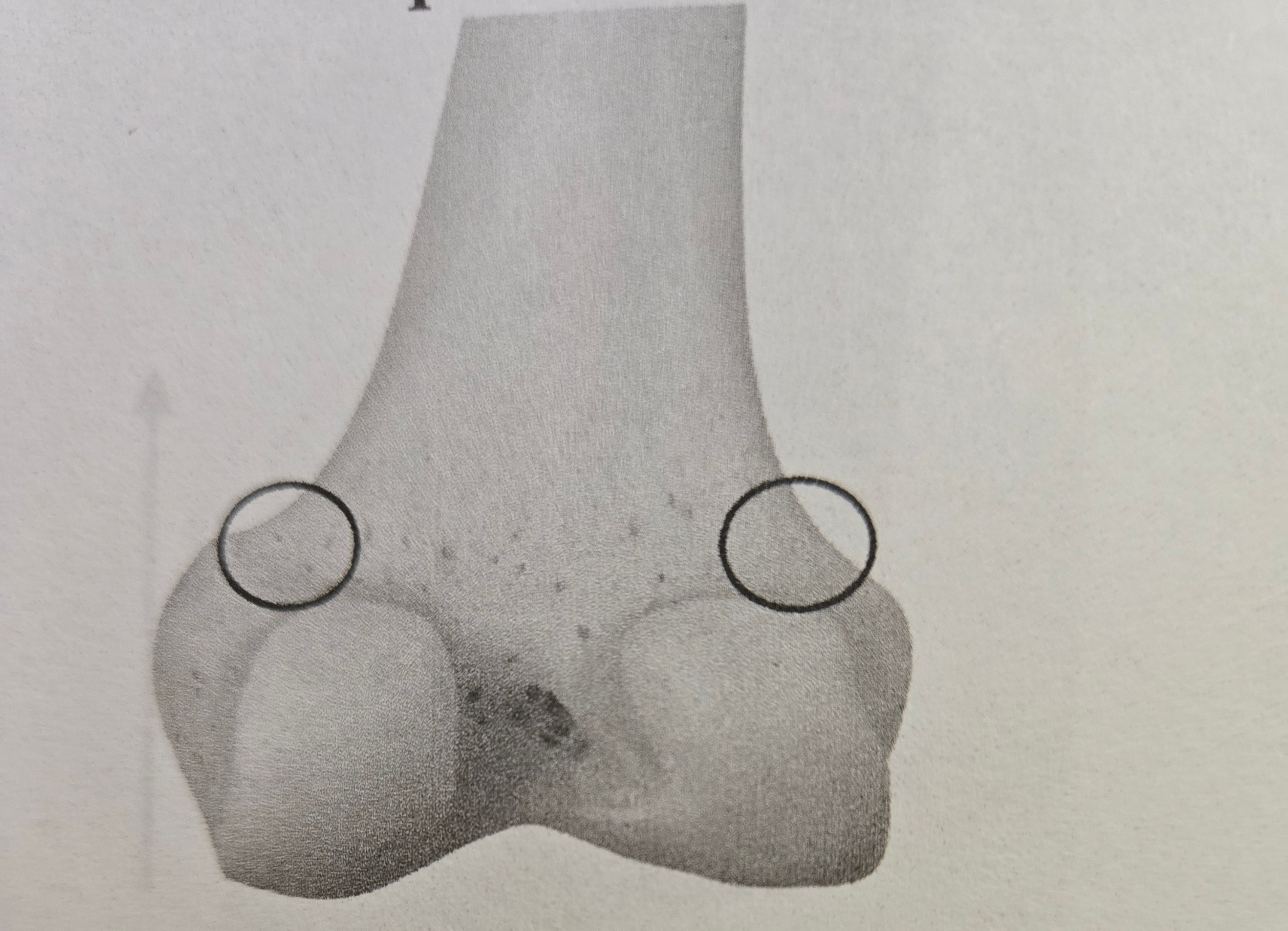 <p>Epicondyle</p>