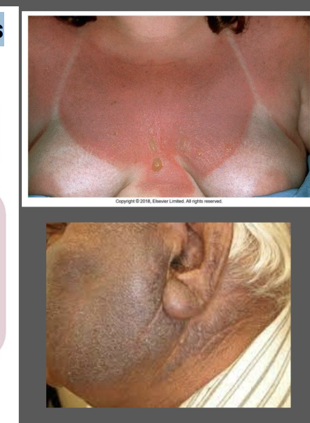 <p>secondary to a cell-mediated hypersensitivity to an allergen activated or produced by the effect of light on a drug </p><p>typically appears more eczematous</p><p>can be result of chronic dermatitis </p><p>involves both sun-exposed and non-sun exposed sites</p><p>secondary to quinolones, solfonamides, antimalarials, TCAs</p>