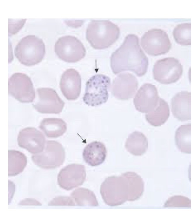 <p>What is anemia of chronic disease </p>