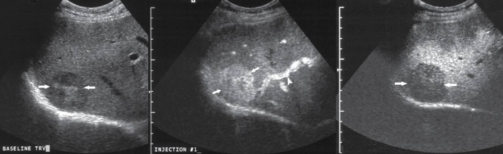 <p>what lesion is seen on this CEU?</p>