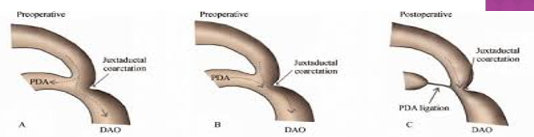 <p>narrowing of ao isthmus as its junction with prox descending ao at insertion of arterial duct (lig arteriosum) </p><ul><li><p><strong>basically where lig art inserts into ao</strong></p></li></ul><p></p>