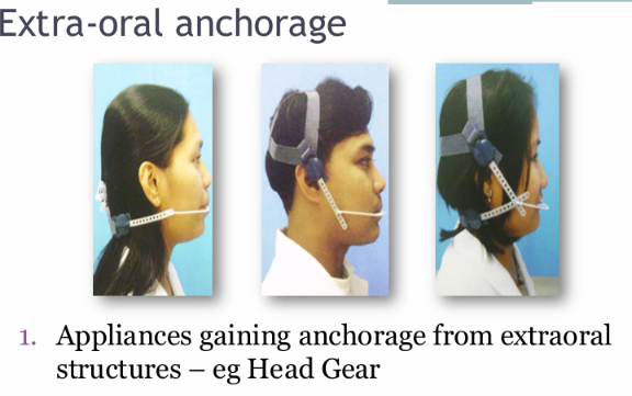 <ul><li><p>cervical pull or Low pull head gear</p></li><li><p>Occipital head gear - high pull</p></li><li><p>Combination pull head gear</p></li></ul><p></p>