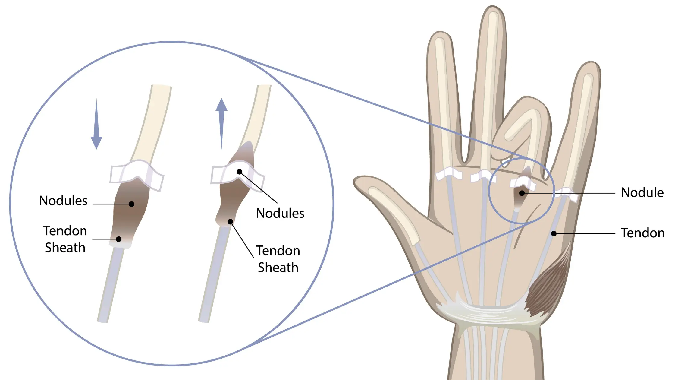 <p>Define this hand pathology</p>