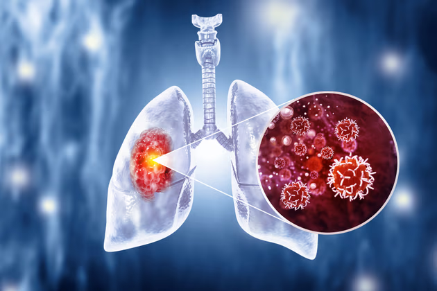 <p>Smoking can cause _____</p>