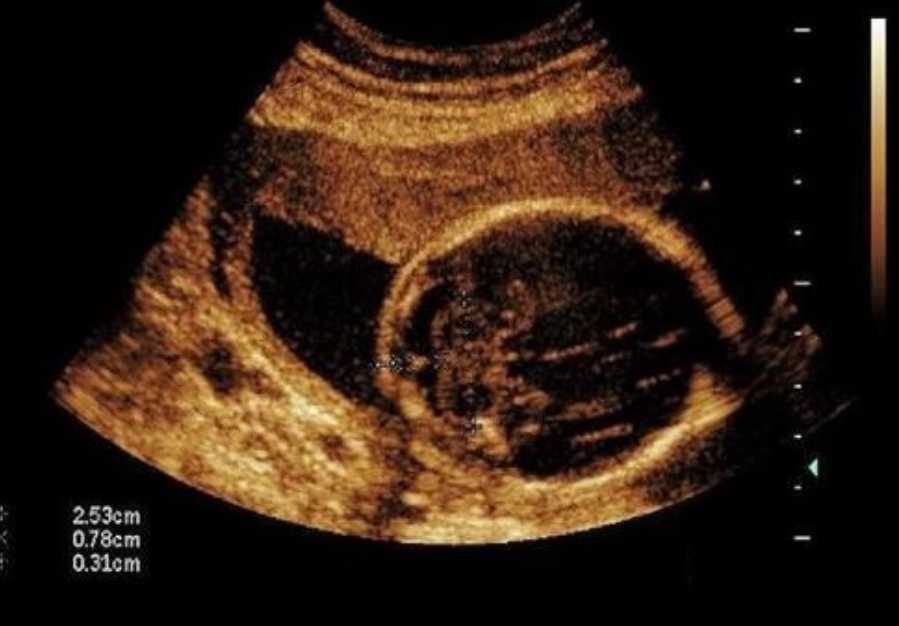 <p>What is the location of the placenta?</p><p>A. anterior</p><p class="p1">B. posterior</p><p class="p1">C. fundal</p><p class="p1">D. low lying</p>