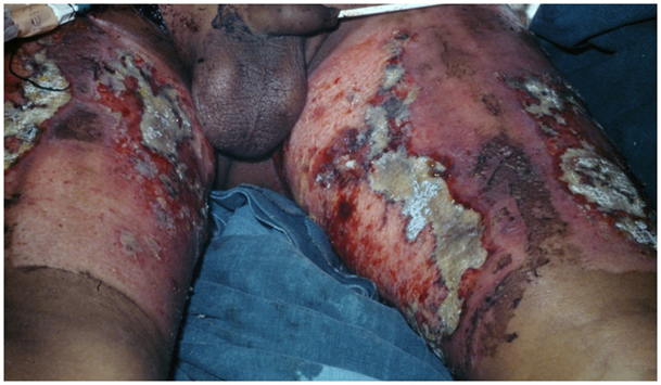 <p>Causative Agent: Methicillin-resistant Staphylococcus aureus (MRSA) and other staphylococci, Pseudomonas aeruginosa, and sometimes Aspergillus and Candida fungi</p>