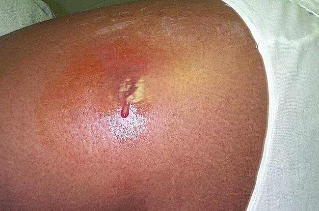 <p>Walled-off collection of pus in the skin, usually from Staph Aureus </p><p>-Presentation: painful, fluctuant, red nodule with surrounding cellulitis </p><p>-RF: skin trauma, injection drug use, diabetes, immunocompromise, MRSA contacts </p><p>-Dx: clinical, fluctuance is the key finding </p><p>-Tx: I&amp;D is definitive + cephalexin / bactrim if MRSA coverage is needed </p>