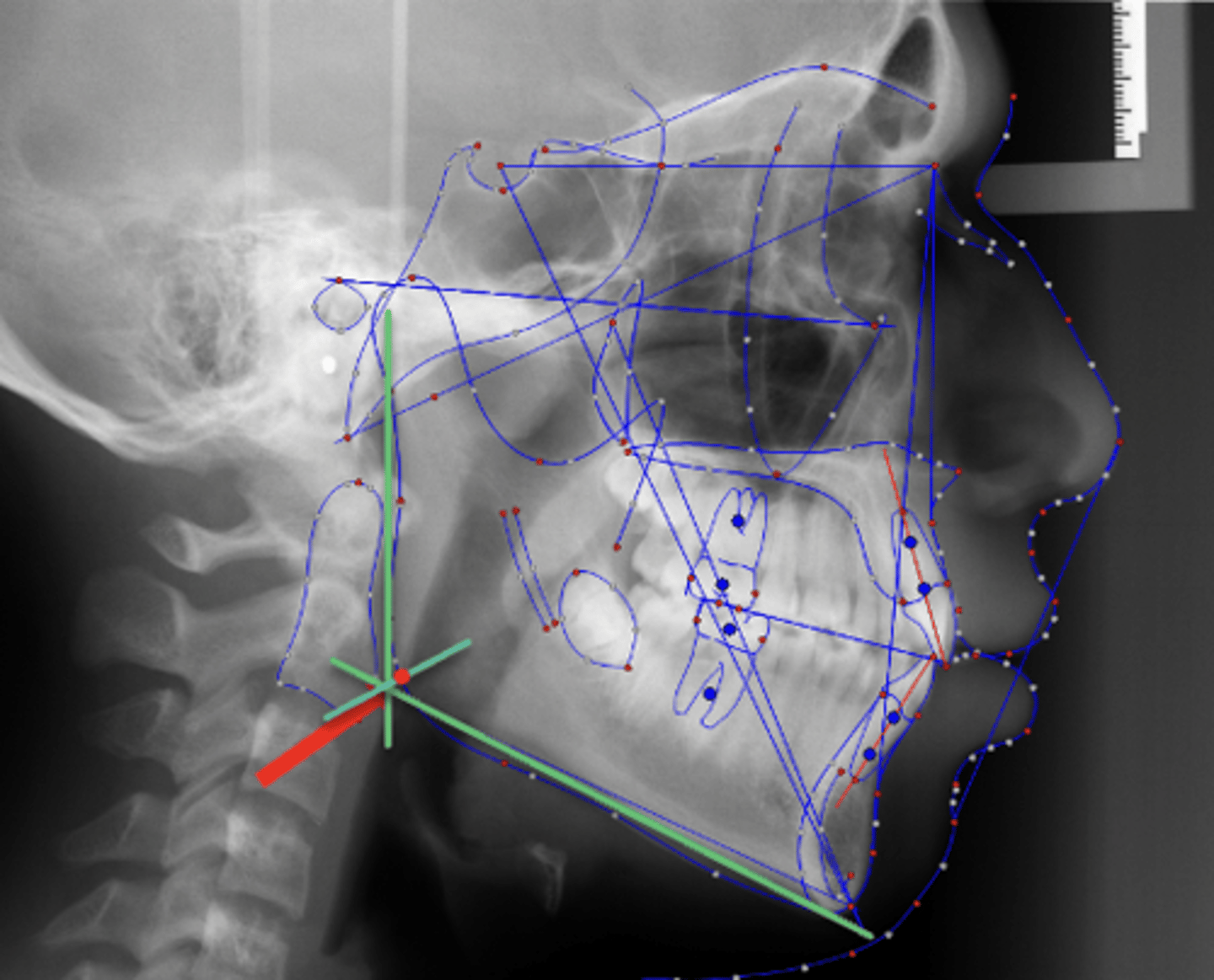 <p>which anatomical landmark:</p><p>- The intersection of the mandible and the line that bisects the angle formed by Menton-Gonion and Articulare-Ramus Point</p>