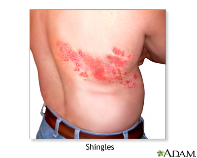 <p>Shingles</p>