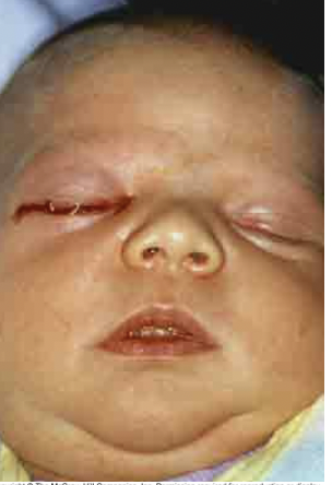 <p>Newborn <u>conjunctiva</u></p><ul><li><p>Organism: Chlamydia trachomatis or Neisseria gonorrhoeae</p></li><li><p>Transmission: During vaginal birth</p></li><li><p>Prevention: All newborns treated</p></li><li><p>Treatment: <u>Antibiotic</u> eye drops/ointment</p></li><li><p>Epidemiology: Newborns</p></li></ul><p></p>