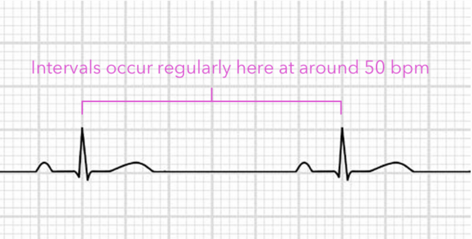 <p>Regular rhythm, normal P before every QRS, but rate <60 bpm</p><ul><li><p>Occurs because the SA node <strong>fires</strong> at an abnormally <strong>slow</strong> rate due to abnormally <strong>slow</strong> <strong>automaticity</strong> (electrical impulse formation)</p></li></ul><p></p>
