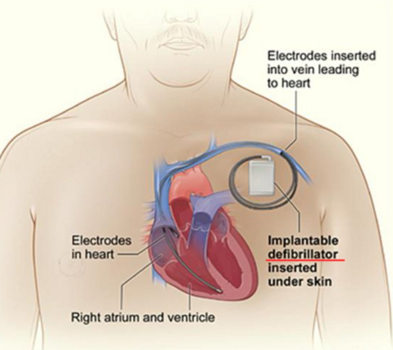 <p>doesn't fire at all times like pacemaker</p><p>corrects arrhythmias</p>