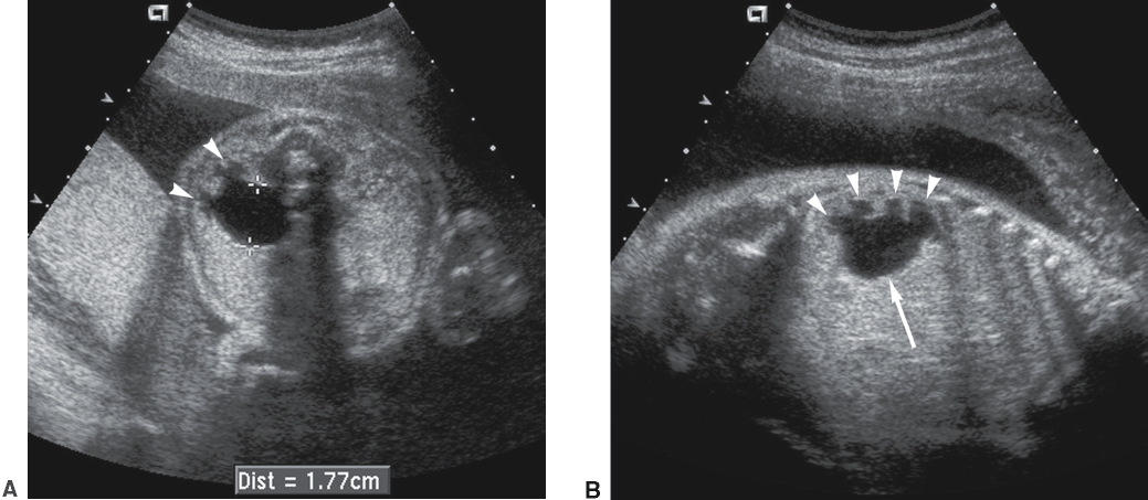 <p>Hydronephrosis (dilated renal pelvis and calices)</p><p>Normal ureters (nonvisualization)</p><p>Normal bladder</p>