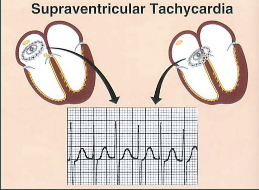 <p>What defines PSVT/SVT?</p>