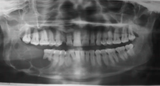 <p>multilocular “soap bubble” radiolucency in posterior mandible. which DDx is correct? </p><p>ameloblastoma, DC, odontoma </p><p>cerubism, OKC, ameloblastic fibroma </p><p>OKC, GOC, ameloblastoma </p><p>GOC, odontogenic myxoma, COC </p>