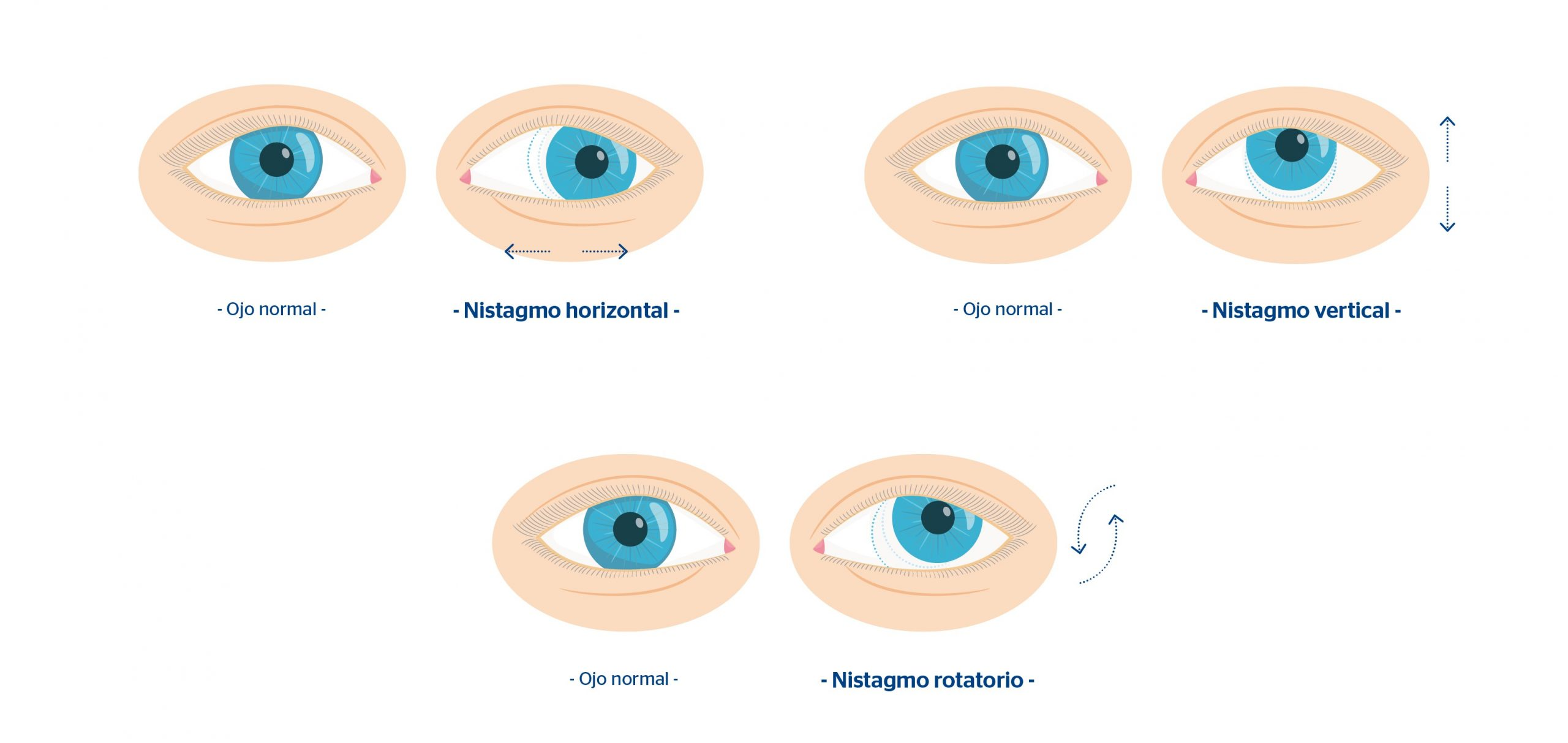 <p>Presenta <strong>nistagme</strong> (moviment ocular) i <strong>Romberg Positiu</strong> (cau cap al costat lesionat).</p>