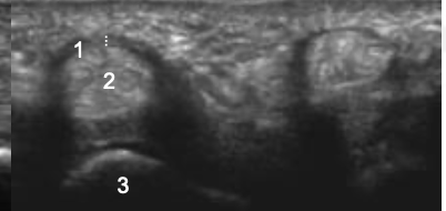 <ol><li><p>Thickened A1 pulley</p></li><li><p>Tendon thickening compared to adjacent tendon. Also note tendon is thicker distal to A1 puley. On dynamic imaging, this impinged onto the A1 pulley.</p></li><li><p>MCP</p></li><li><p>Phalanx</p></li></ol><p></p>