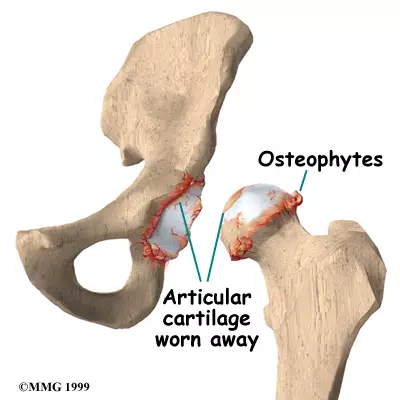 <p>Irregular bony/cartilaginous nodule</p>