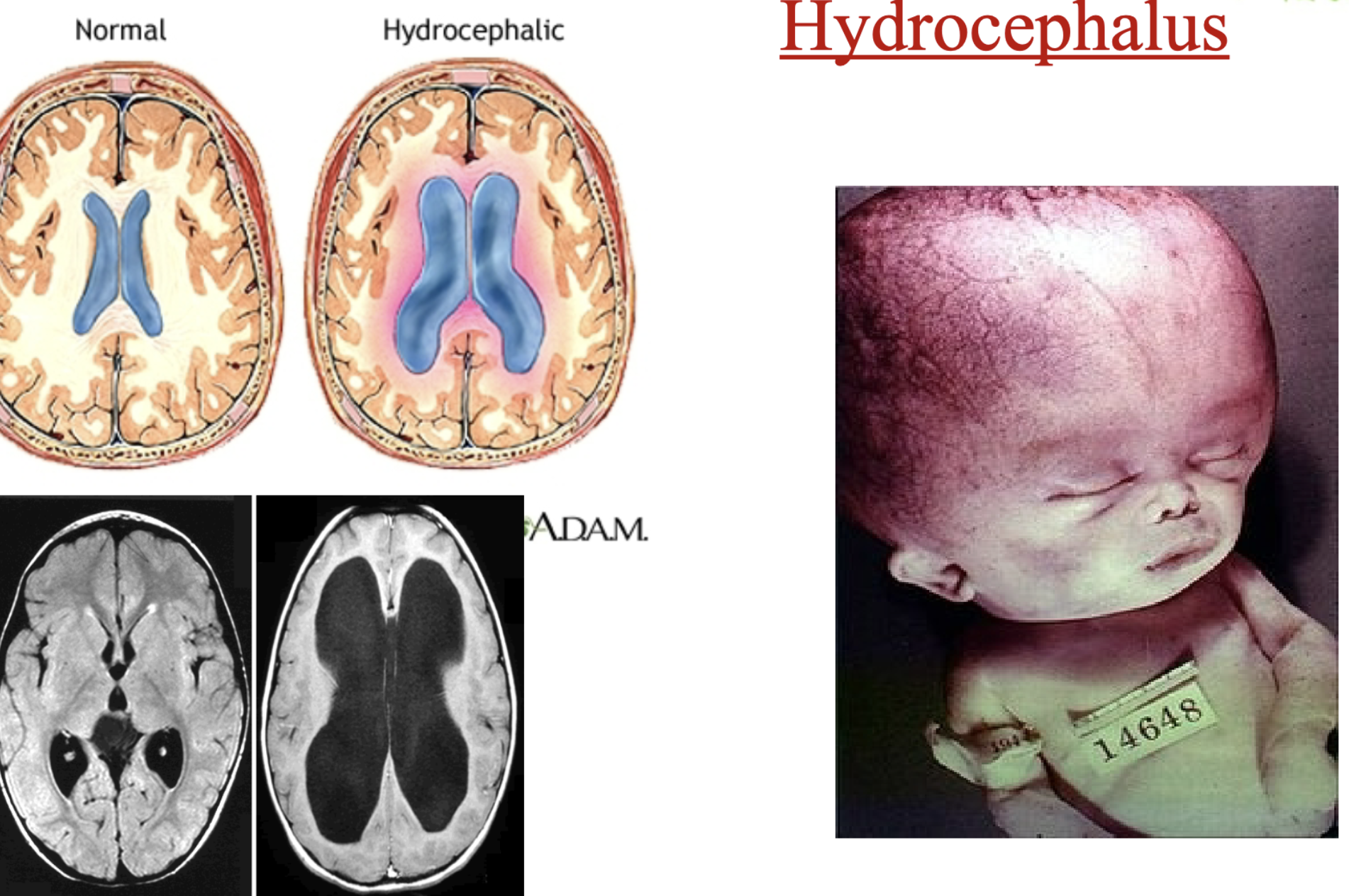 <ol><li><p>hydrocephalus <strong>collection of CSF in <u>brain ventricles</u></strong></p></li><li><p><strong>a side effect </strong>of <u>down syndrome</u></p></li><li><p>can be treated by <strong>aspirating fluid</strong> (draining it)</p></li></ol><p></p>