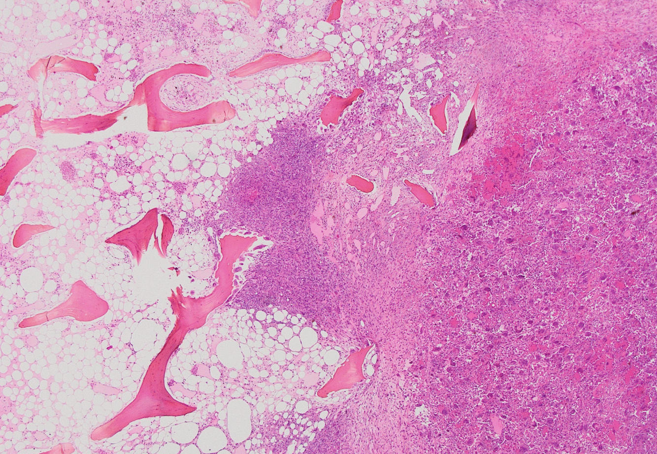 <p>Tumeur os long patient de 40 ans </p><p>diagnostic</p><p>définition</p><p>age</p><p>anatomie</p><p>histologie</p><p>IHC et moléculaire</p>