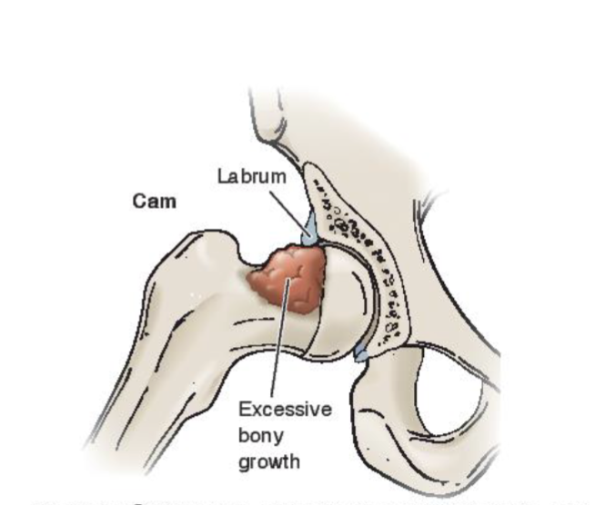 <p>FAI (<span>Femeroacetabular Impingement) </span></p>