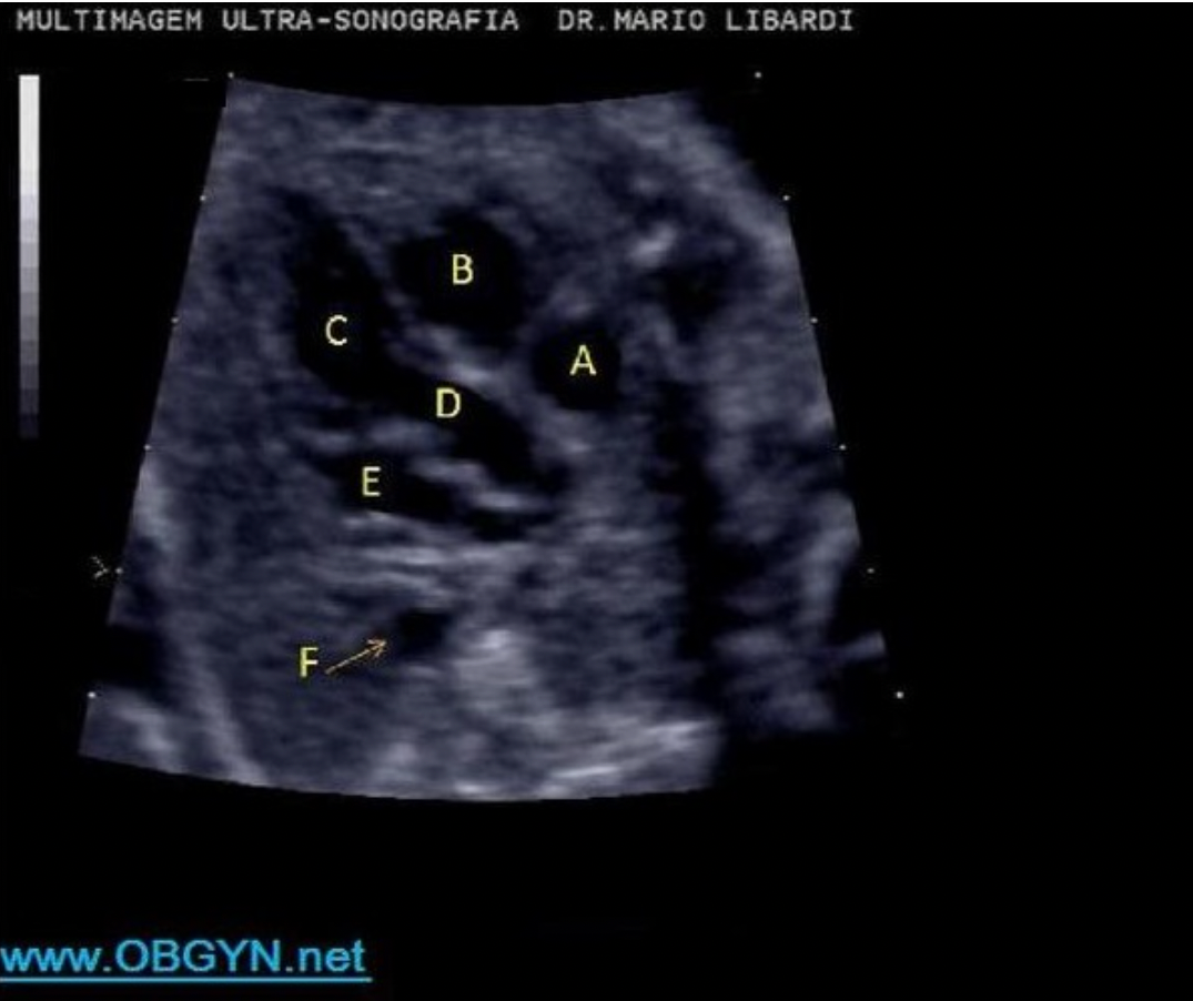 <p>Letter D indicates which cardiac structure?</p><p>A. RVOT</p><p class="p1">B. left ventricle</p><p class="p1">C. right ventricle</p><p class="p1">D. LVOT</p><p class="p1">E. right atrium</p>