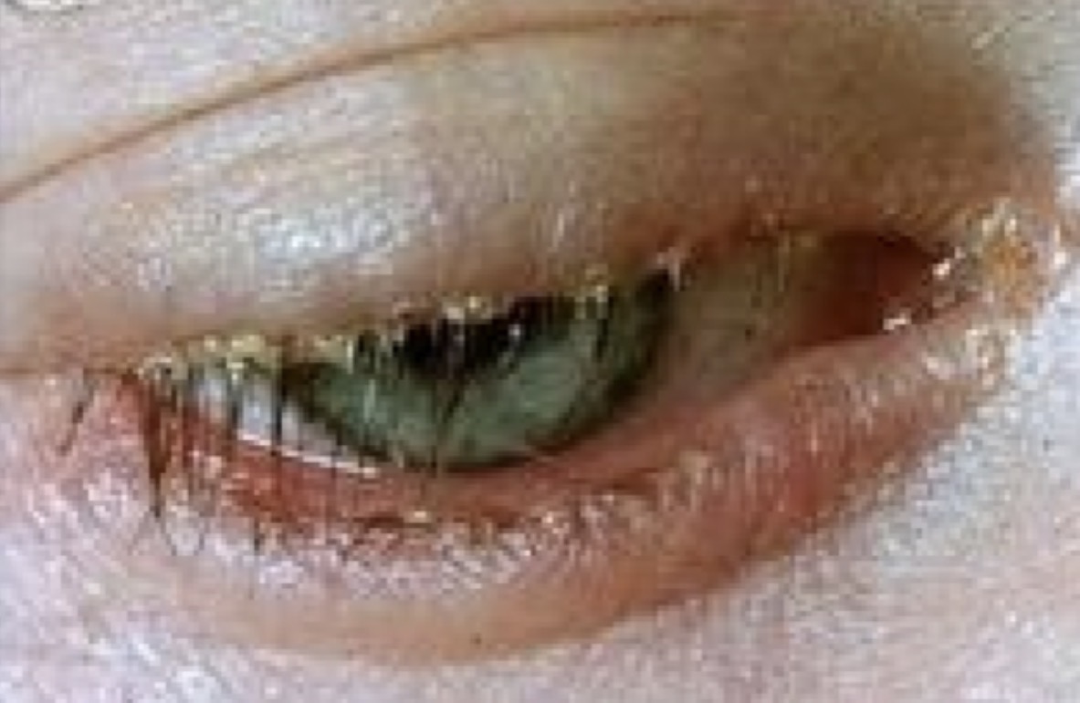 <p><span>Un homme de 55 ans vous consulte parce qu'il se plaint de rougeur des paupières depuis plusieurs mois et d’yeux collés au réveil le matin. Parmi les énoncés suivants, lequel est FAUX concernant sa condition ?</span></p><p></p><p><span>A. ﻿﻿﻿Suggestive d'une conjonctivite à adénovirus</span></p><p><span>B. Cette condition est causée par une dysfonction des glandes de Meibomius</span></p><p><span>C. ﻿﻿﻿Se traite habituellement par des antibiotiques topiques</span></p><p><span>D. Peut être associée à des ulcères cornéens inflammatoires</span></p>