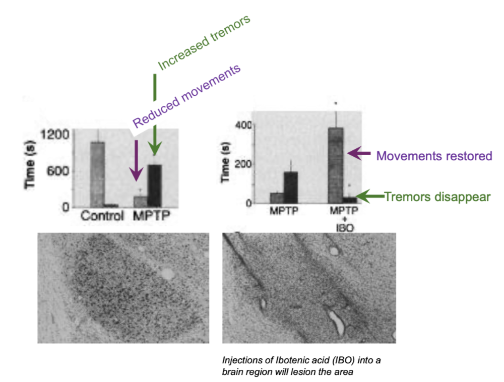 <p>GPi/SNr inhibits motor centres and prevents movement inhibition </p><p>A possible reason for akinesia in PD is hyperactivity in GPi/SNr or the STN</p><ul><li><p>loss of inhibition of motor centres > overactive movement control stimulation</p></li></ul><p>Akinesia and tremors can be ameliorated by selectively lesioning the sub-thalamic nucleus</p><ul><li><p>lesions inhibit GPi, releasing motor centre inhibition</p></li></ul><p></p>