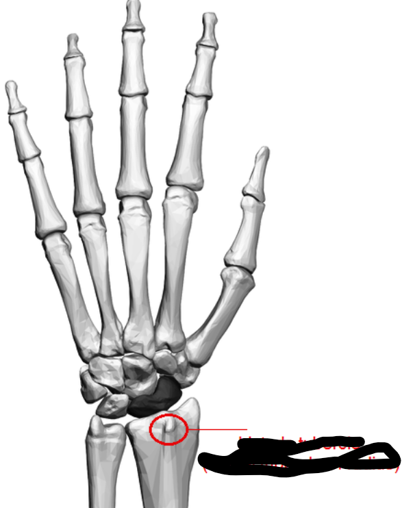 <p>What bone landmark is this within the <strong>Radius </strong></p><ul><li><p>(Lateral Forearm Bone, <strong>Antebrachial / Radial Region)</strong></p></li></ul><p></p>