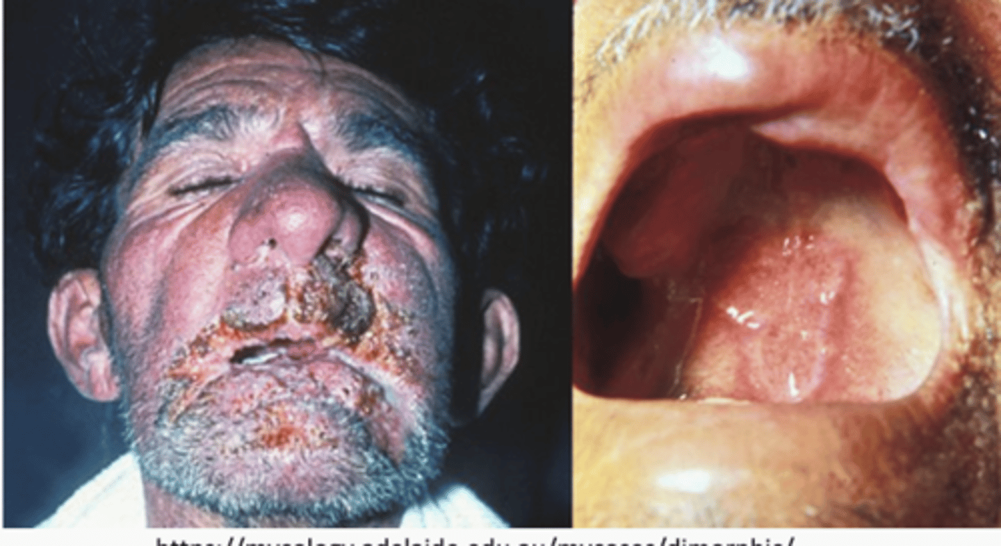 <p>- Paracoccidioidomycosis (TB type lesions)</p><p>- Mucocutaneous paracoccidioidomycosis (oral mucosa and gums, crusted ulcers)</p><p>- Visceral paracoccidioidomycosis (intestines, liver, spleen, adrenals)</p>