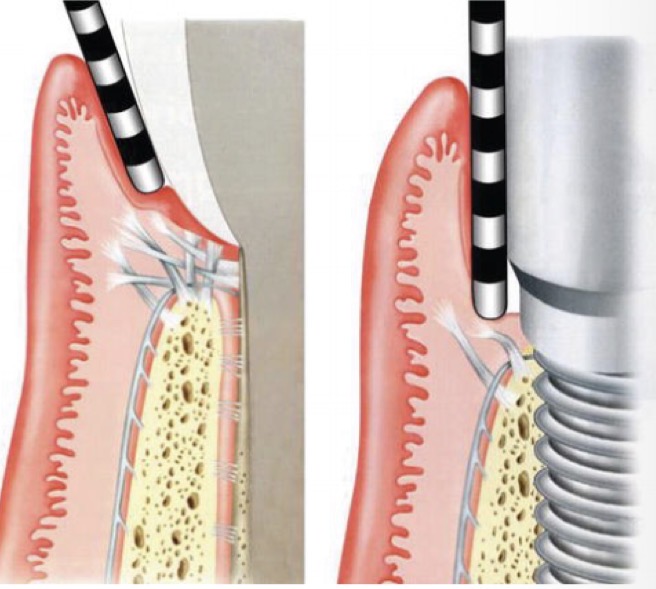 <p>Always use same perio probe</p><p>For healthy patients- range broader- no CT so pd deeper already</p><p>Determined by <strong>prosthesis emergence </strong>(angle at which prosthesis coming out)</p><p>Remove prosthesis for reliable measurements </p><p>Maybe resistance, compare to initial records, gentle force</p><p>Bleeding suggests instability, positive predicative value greater </p>