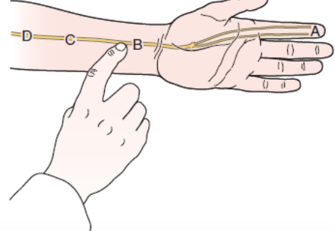 <ul><li><p><span>PURPOSE-Identify carpal tunnel compression of median nerve</span></p></li><li><p><span>DESCRIPTION- The examiner taps over the carpal tunnel at the wrist</span></p></li><li><p><span>RESULT- A positive test causes tingling or paresthesia into the thumb, index finger, and middle and lateral half of the ring finger. Tinel sign at the wrist is indicative of a carpal tunnel syndrome.</span></p></li></ul><p></p>