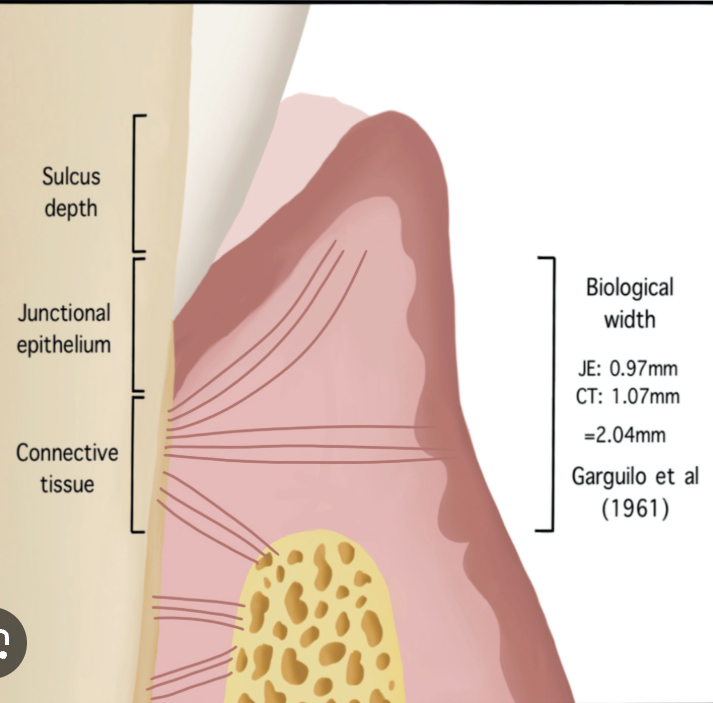 <p>⢠Sulcus depth = 0.69mm</p><p class="p1">⢠Epithelial Attachment = 0.97mm</p><p class="p1">⢠Connective tissue = 1.07mm</p><p class="p1"><strong>basically 1mm each</strong></p>