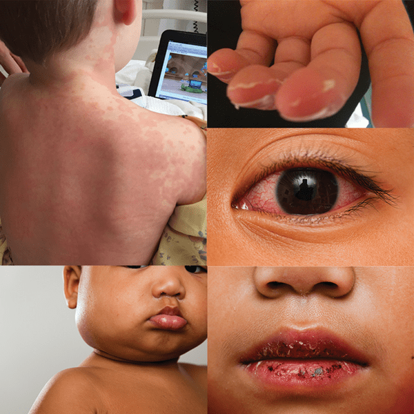 <p>kawasaki disease sx</p>