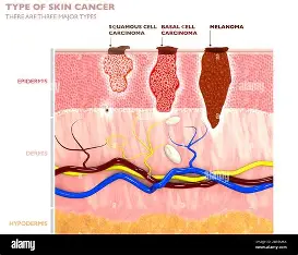 <p>Squamous Cell Carcinoma</p>