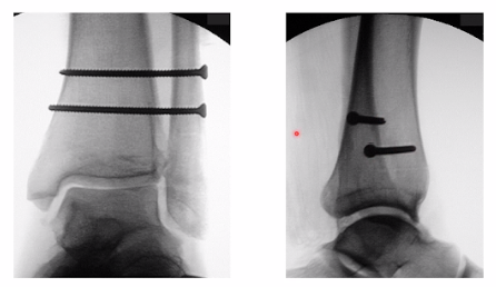 <p>How to treat syndesmotic injuries </p>