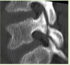 <p>for low back pain in young athletes, think</p>