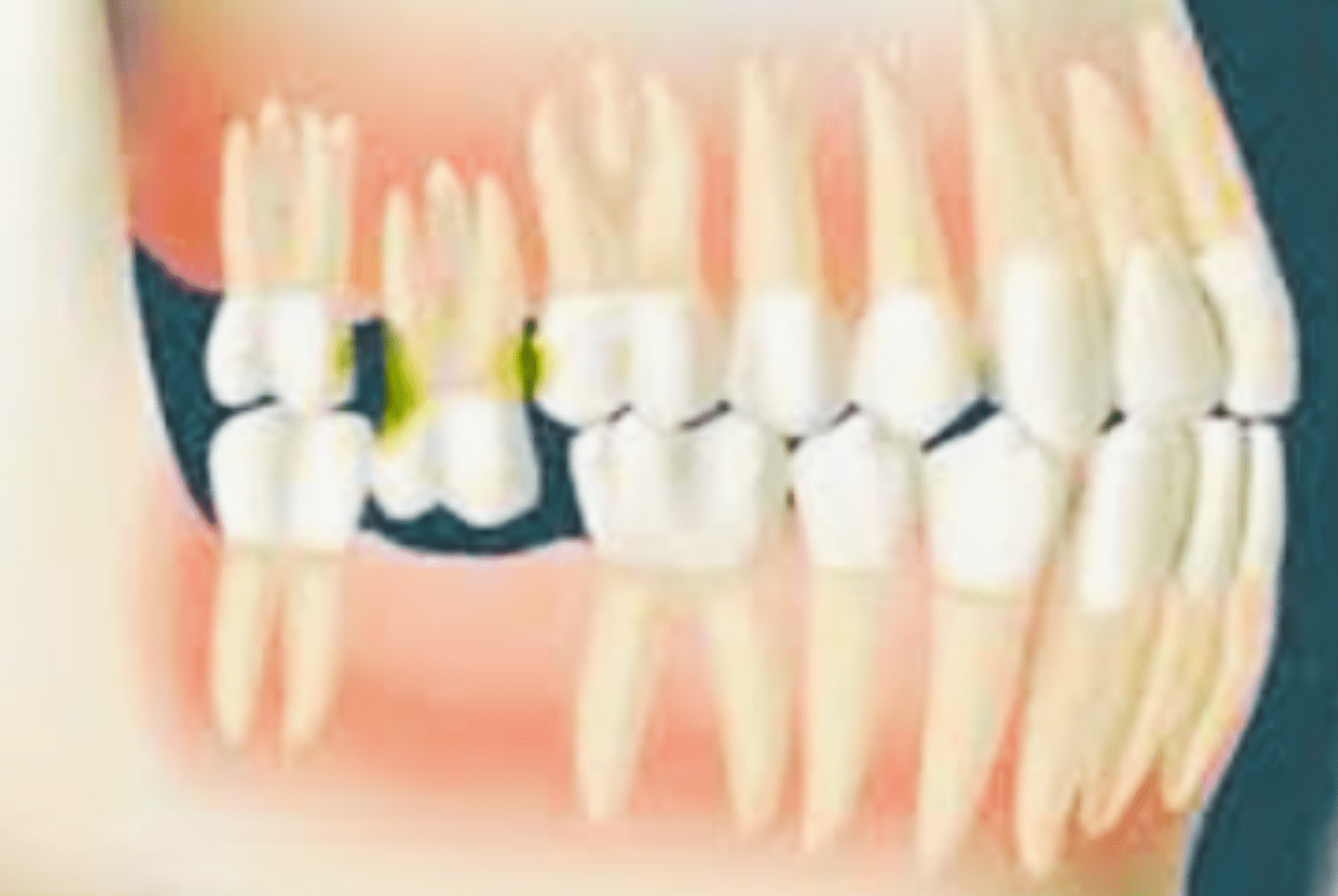 <p>When a tooth erupts <strong>past the normal occlusal</strong> plane, usually due to the loss of its antagonist tooth or teeth from the opposing arch</p>