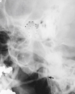 <p><span style="background-color: transparent;">TMJ SCHULLER: open or closed?</span></p>