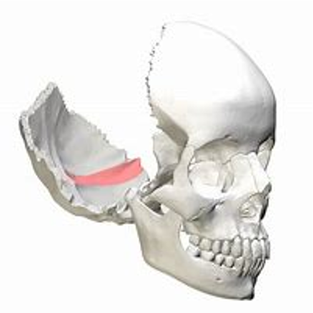 <p>narrow, deeper, elongated groove</p>