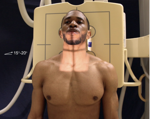 <p>position: Erect or seated, arms down, elevate mandible to level of base of skull, pull shoulders back</p><p></p><p>IR: 10 × 12 portrait</p><p></p><p>breathing instructions: exposure during slow, deep inspiration</p><p></p><p>technique: 75-85, <strong>8</strong>-12</p><p></p><p>SID: 40 (handbook says 72 tho)</p><p></p><p>CR: level of C6-C7, midway between jugular notch and adams apple</p><p></p><p>marker: right marker on the right side (can be left)</p>