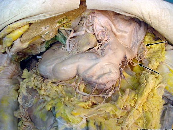 <p>what artery is being indicated to in the image? context: left lobe of liver has been removed</p>
