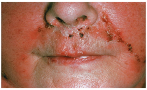 <p>S. pyogenes infect dermal layer of skin causing local tissue destruction and sepsis</p>