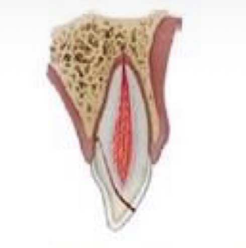 <p>What is an uncomplicated crown root fracture (without pulp exposure)?</p>