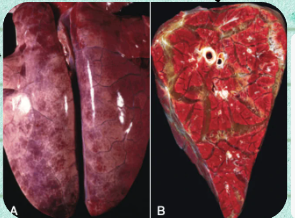 <p>What circulatory disturbance develops when the rate of fluid transudation into the interstitium or alveoli exceeds removal mechanisms, leaving the lungs grossly "wet and heavy"?</p>