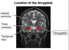 <p>Kluver-Bucy Syndrome (bilateral amygdala lesion)</p>