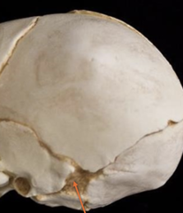 <p>closure at around 12 months</p><p>becomes asterion</p>